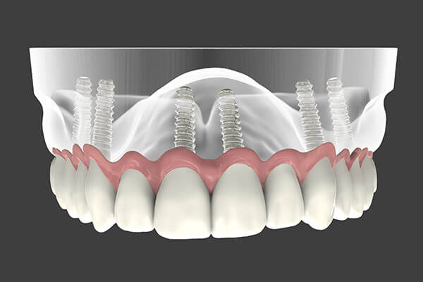 Implant Supported Dentures in Torrington, CT