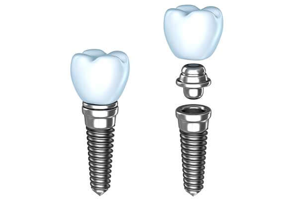 Single Tooth Dental Implants in Torrington, CT