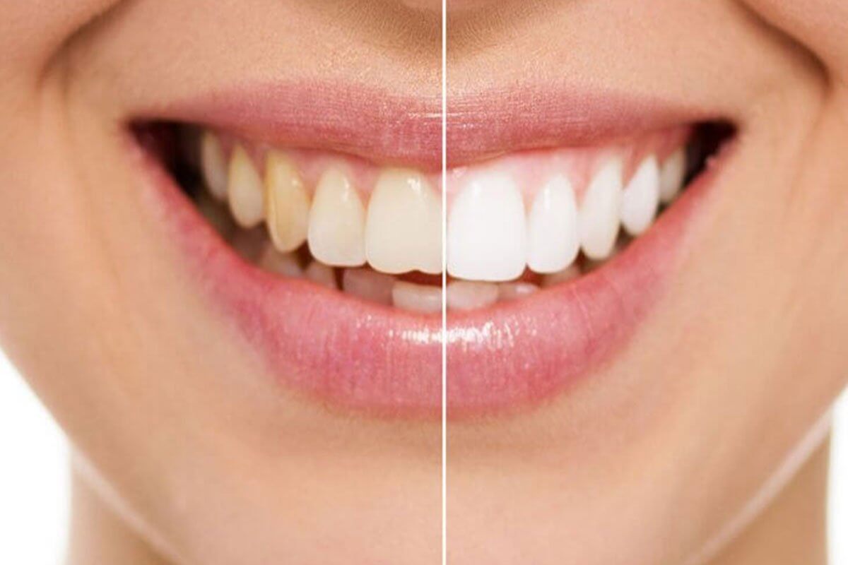 3 Options for Whitening Your Teeth